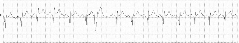 VEB Unspecified Morphology Rhythm Strip